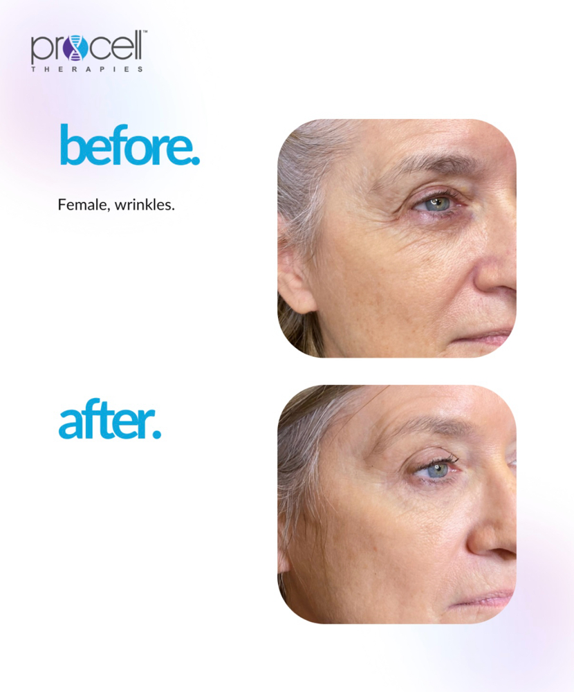 Procell Therapies Anti Aging