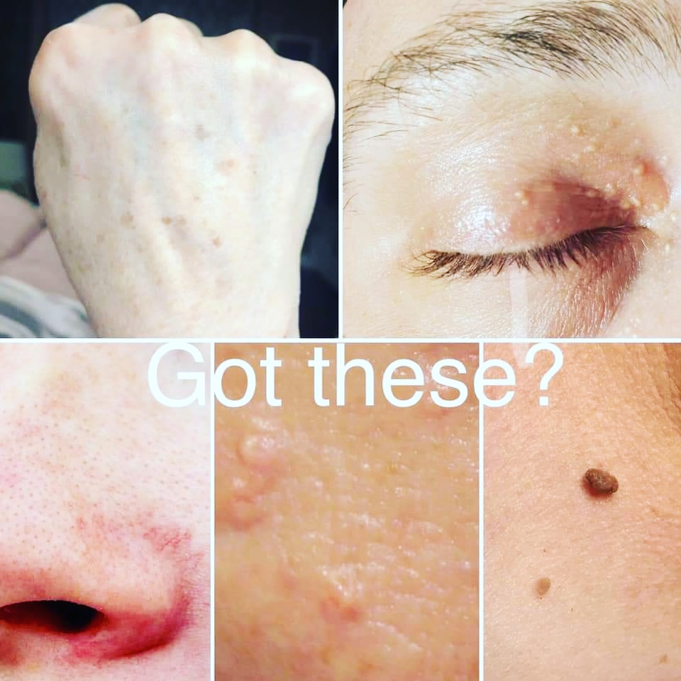 skin tag treatment