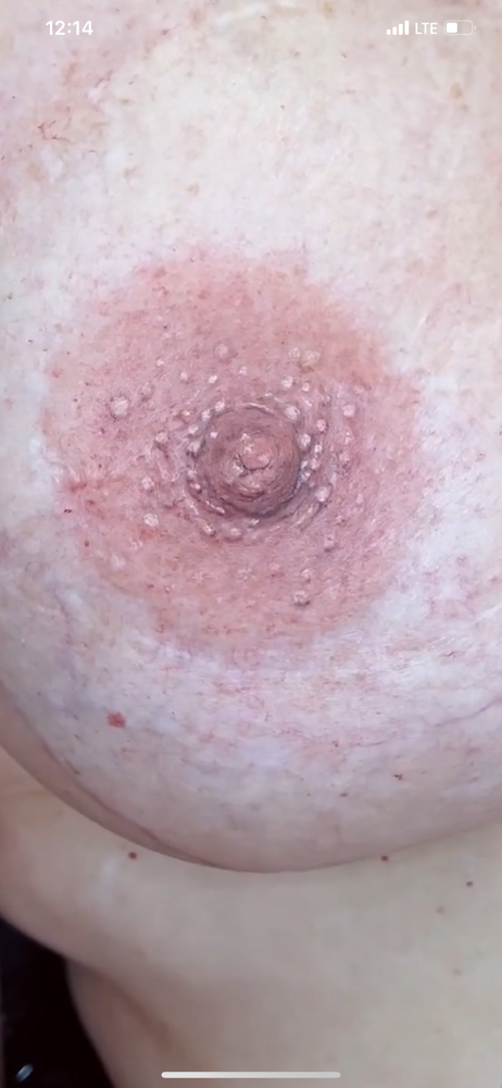 Reconstruccion de Areola 3D at PRIVÉ in Carolina, PR