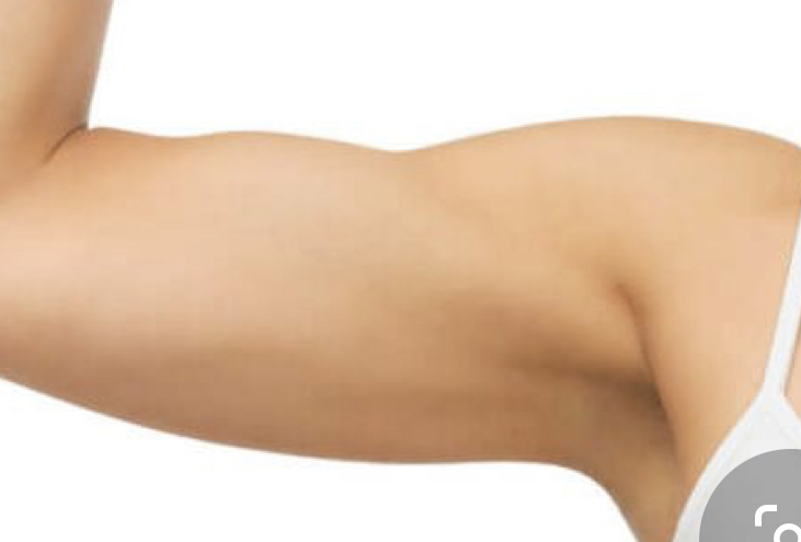 Arm fat reduction