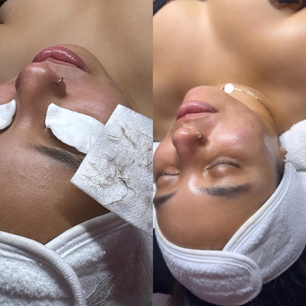 Dermaplaning Facial at TresChic Beauty Lounge in San Diego, CA