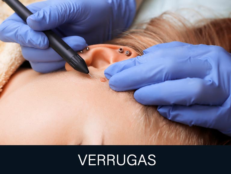 WARTS REMOVAL / REMOCION D VERRUGAS