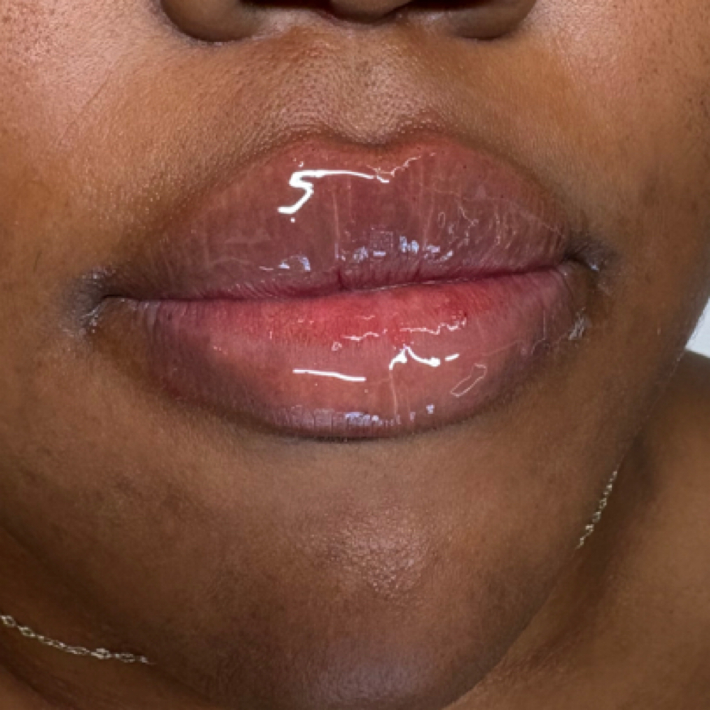 1.5 ML Lip Filler at Eluxy Aesthetics in Arlington, TX