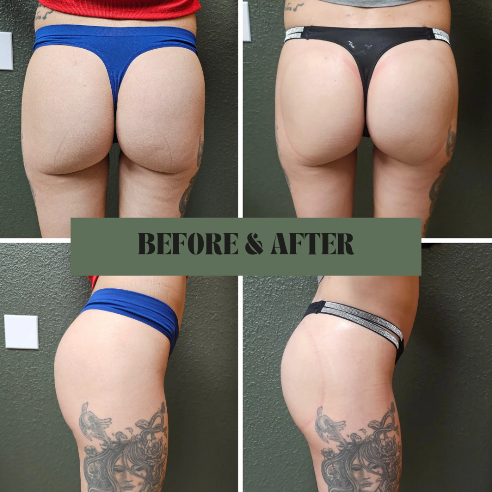 Booty Enhancement