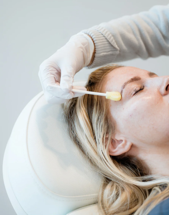Chemical Peel
