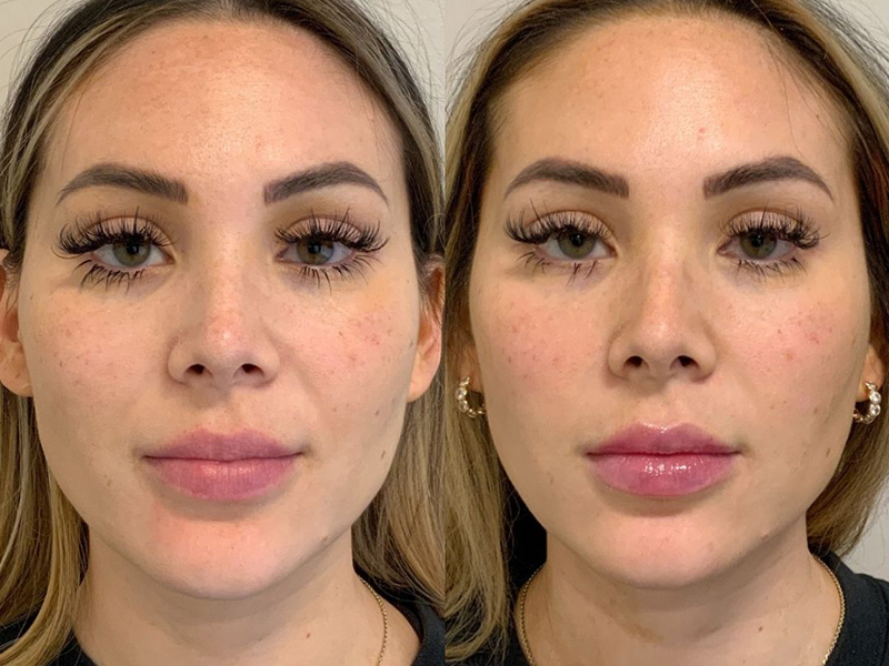 Microneedling Glow Package
