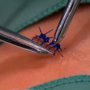 Stitch Removal