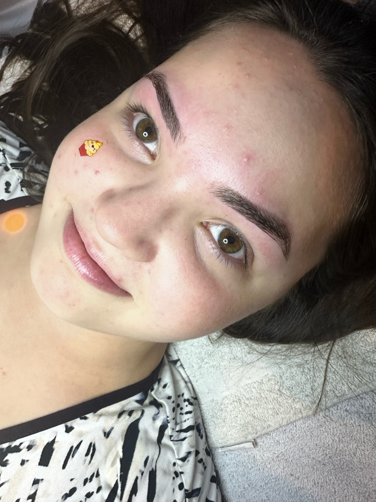 Teens Acne Facial