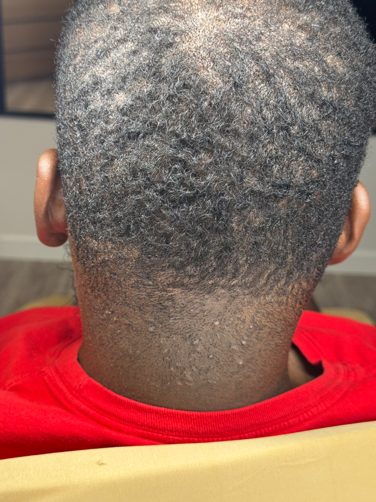 Mens Scalp Treatment