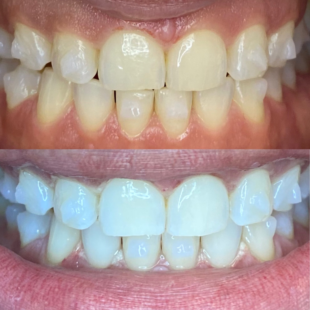 60 Minute Teeth Whitening