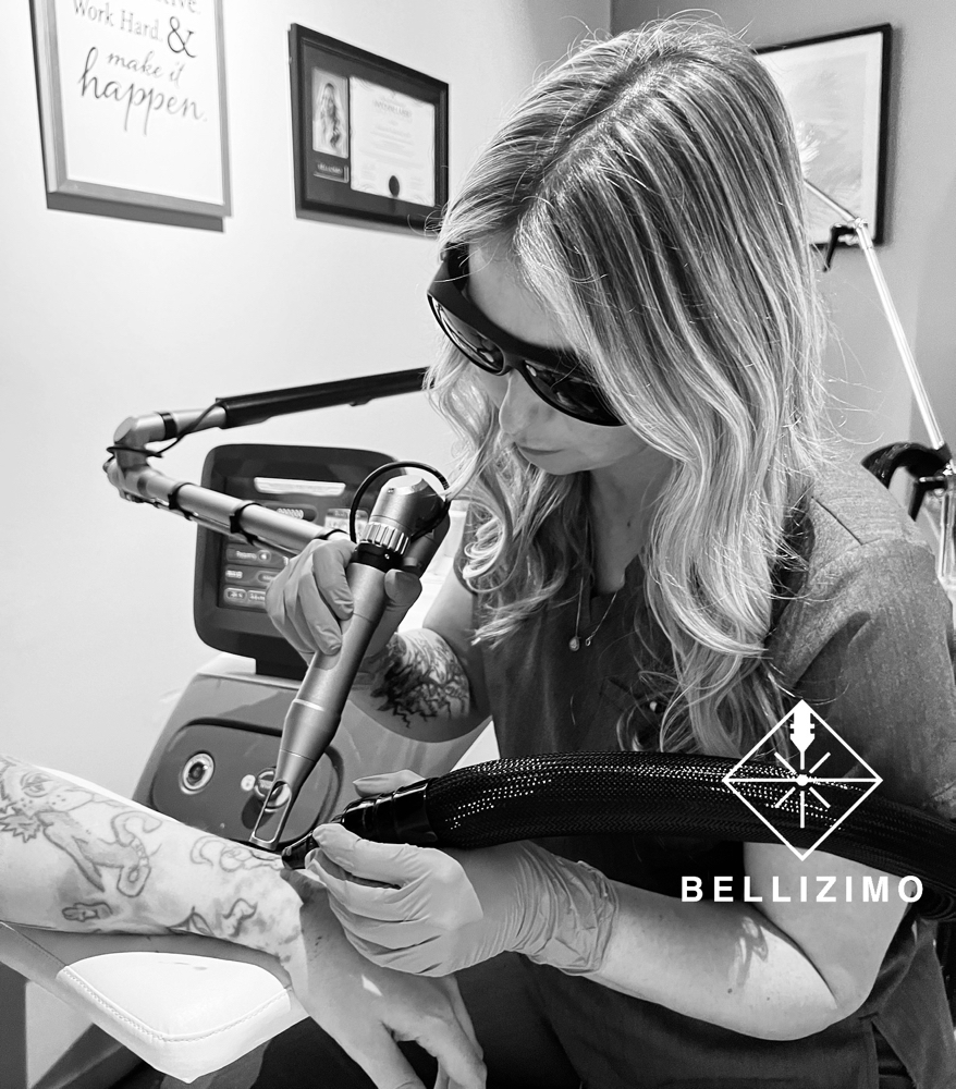 Tattoo Removal
