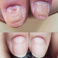 The Nail Treatment