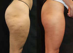 6 Sessions/Smooth & Sculpt Cellulit