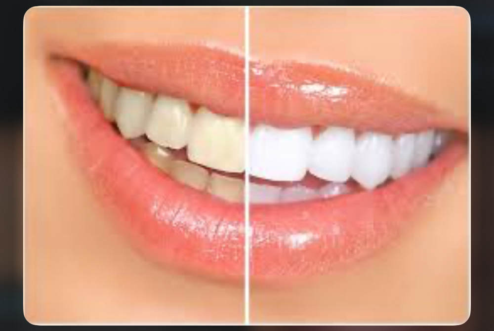 Teeth Whitening at 143Aesthetics_ in Washington, DC