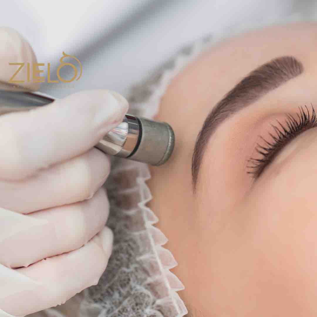 Microdermabrasion