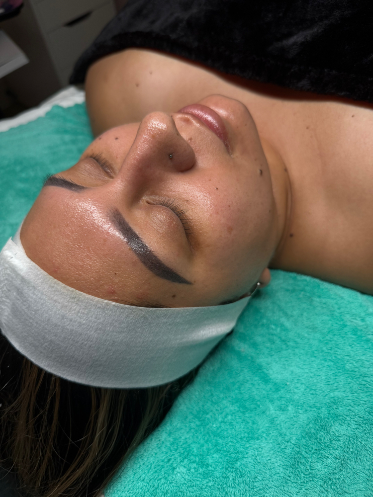 Chemical Peel