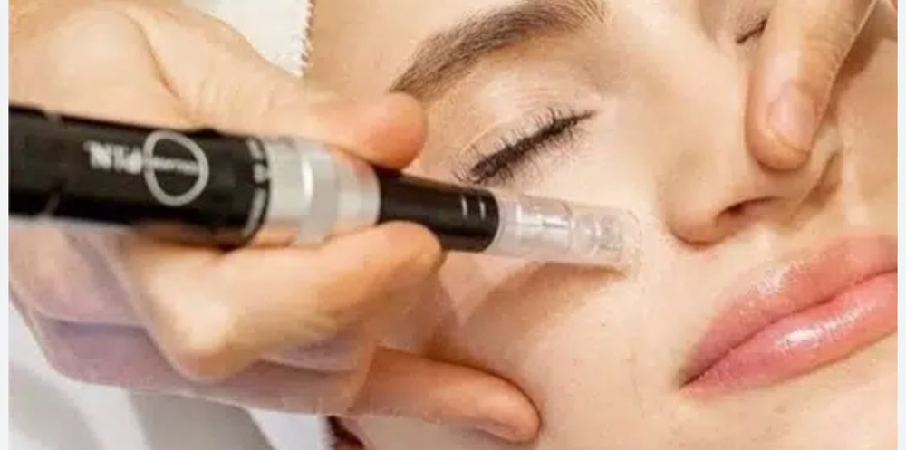 Microneedling