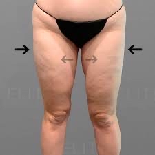 INNER & OUTSIDE THIGH FAT COMBO