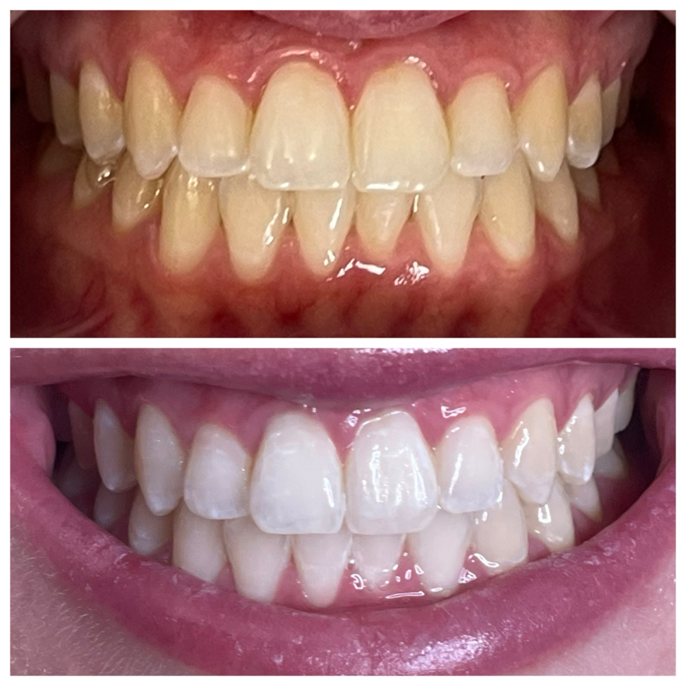 60 Minute Teeth Whitening Session