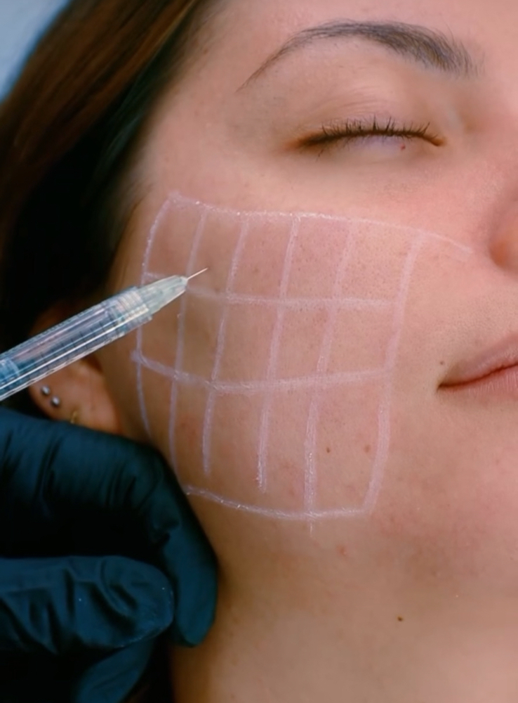 SkinVive (skin Booster) at Lips And Hips Beauty Bar in Modesto, CA