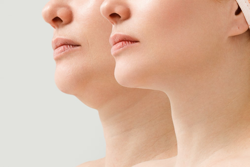 MesoTherapy Double Chin Area