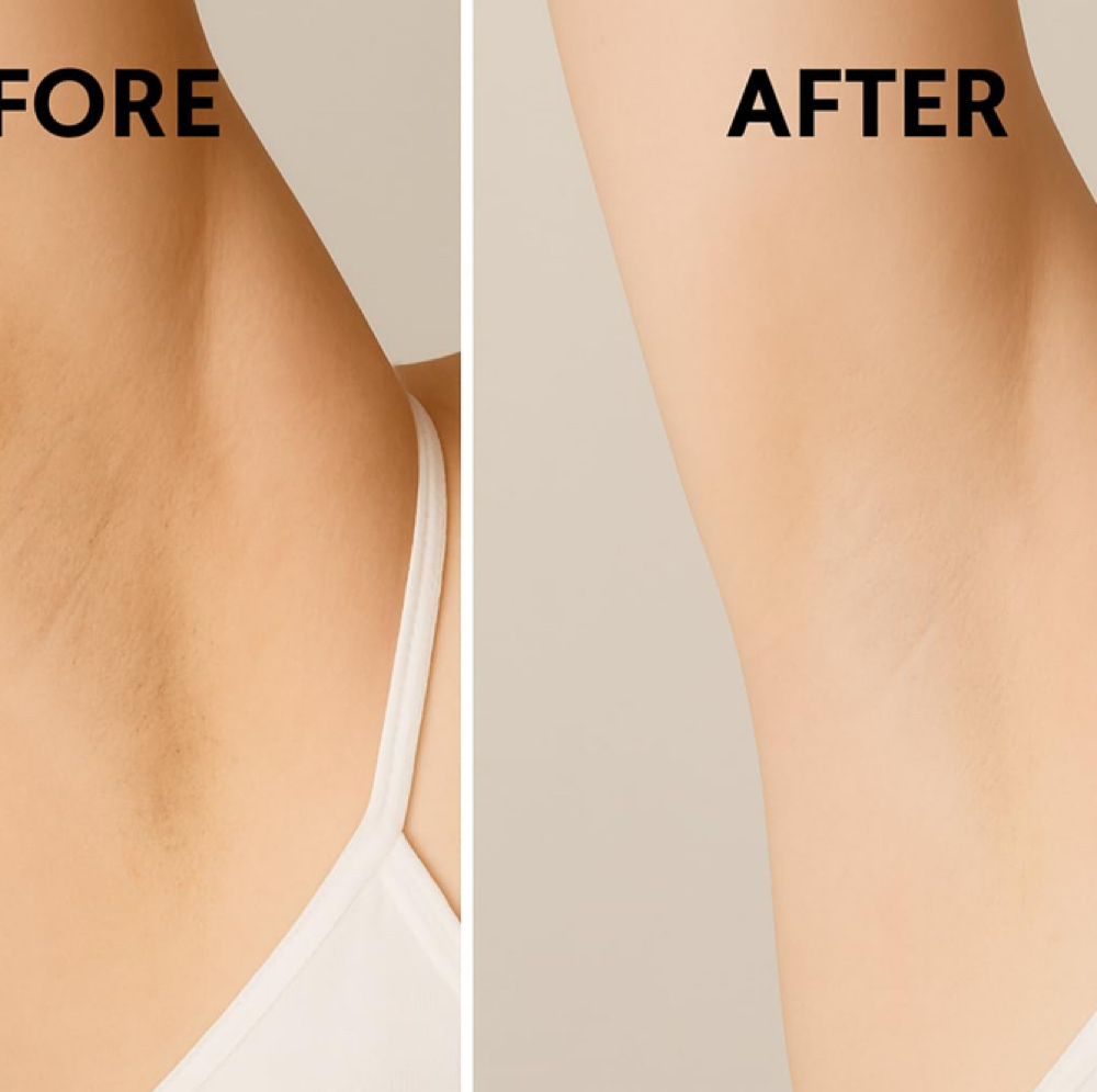Under Arm Tone Correction Package at MediGlow Spa in Spring, TX