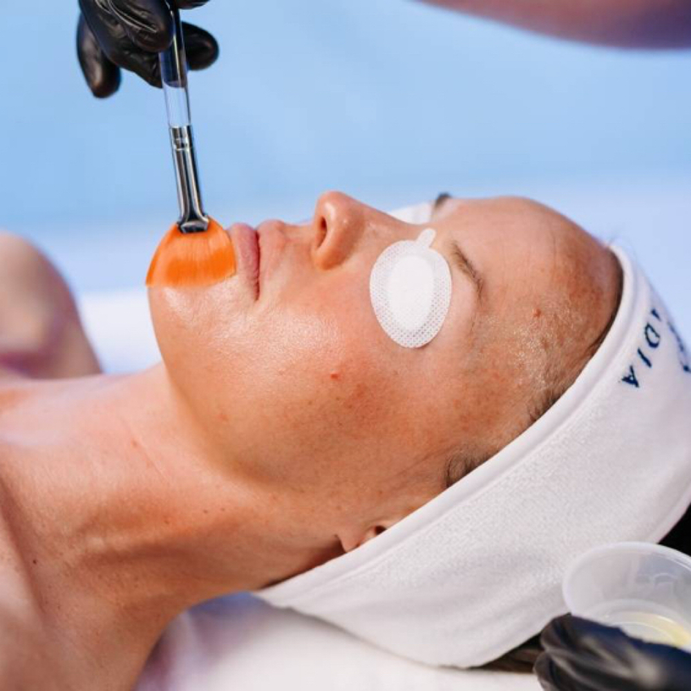 Alpha Beta Peel Add On at Rebel Esthetics in Athens, AL