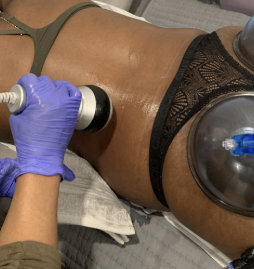 Ultrasound Cavitation