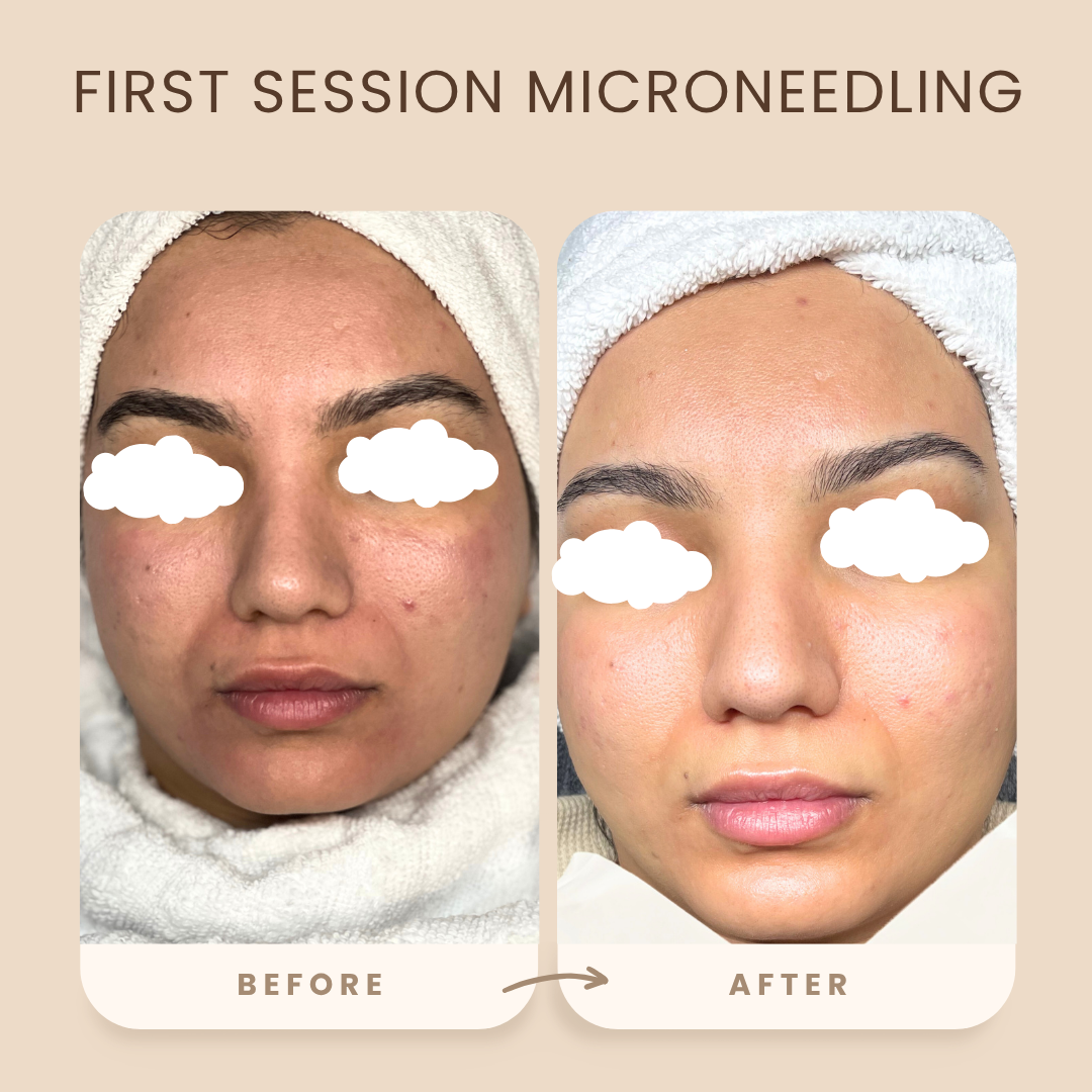 Microneedling