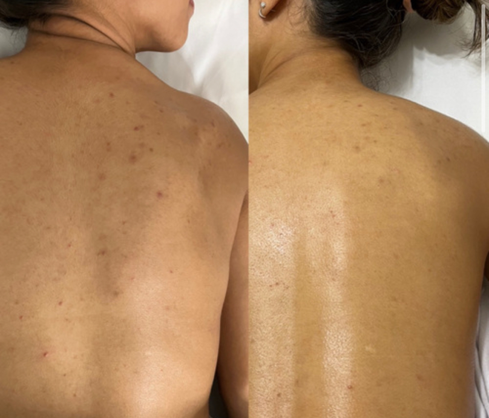 Back Treatment at MylaSkinCare in Los Angeles, CA