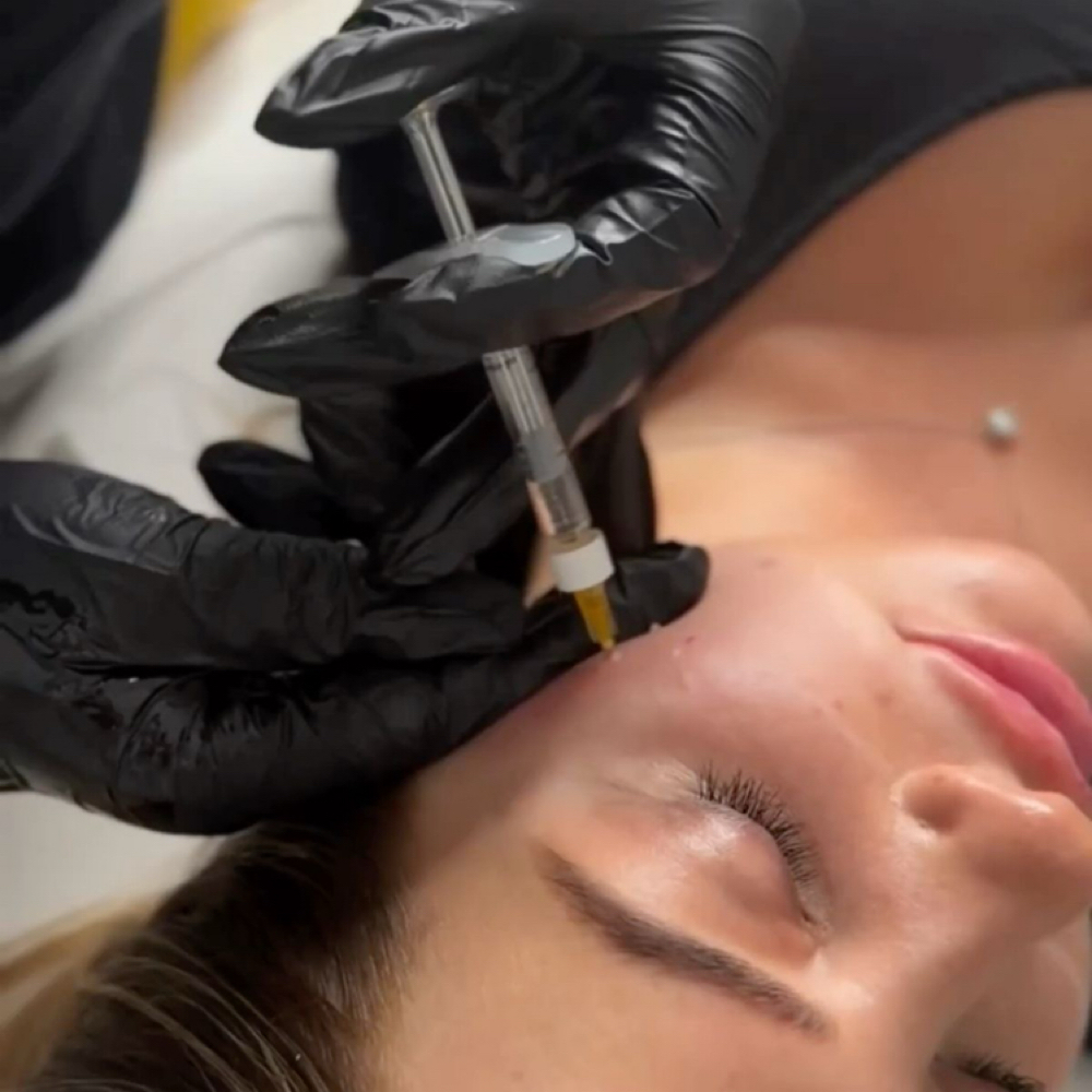 May Special | Cheek Filler at Bare Aesthetics ATX in Austin, TX