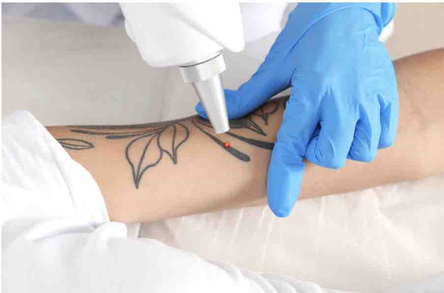 Tattoo Removal at Alisa Brendel - Textür Salon & Spa in Sullivan, MO