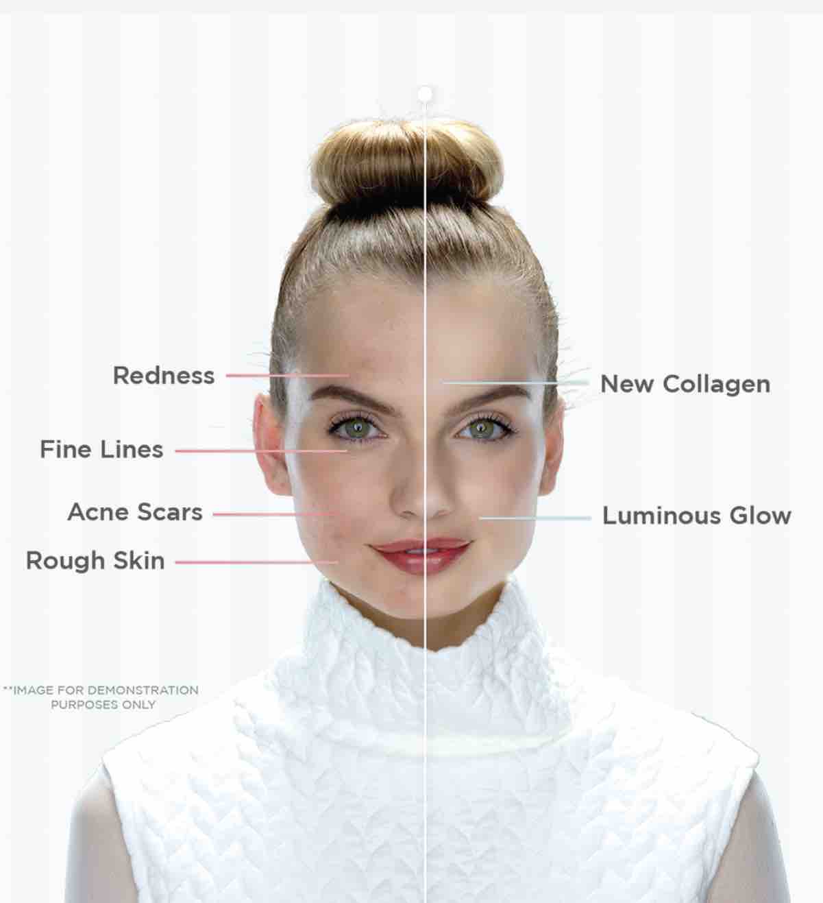 Laser Facials and Sun Spots at Alisa Brendel - Textür Salon & Spa in Sullivan, MO