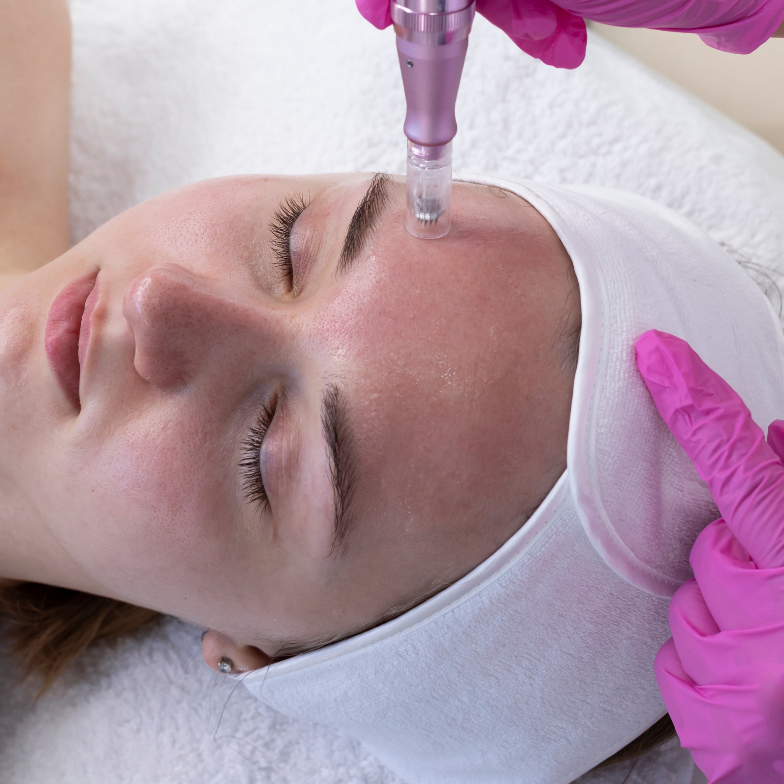 Microneedling at 360 Med Spa Buford in Buford, GA