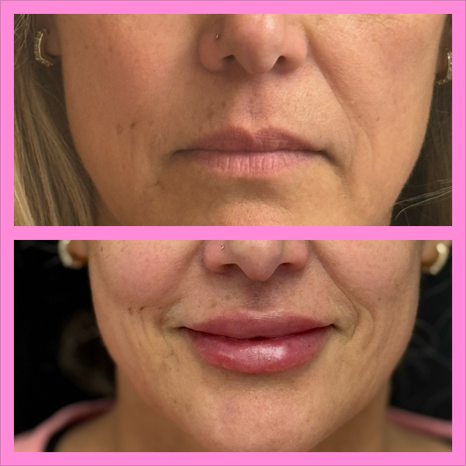 Botox And Filler
