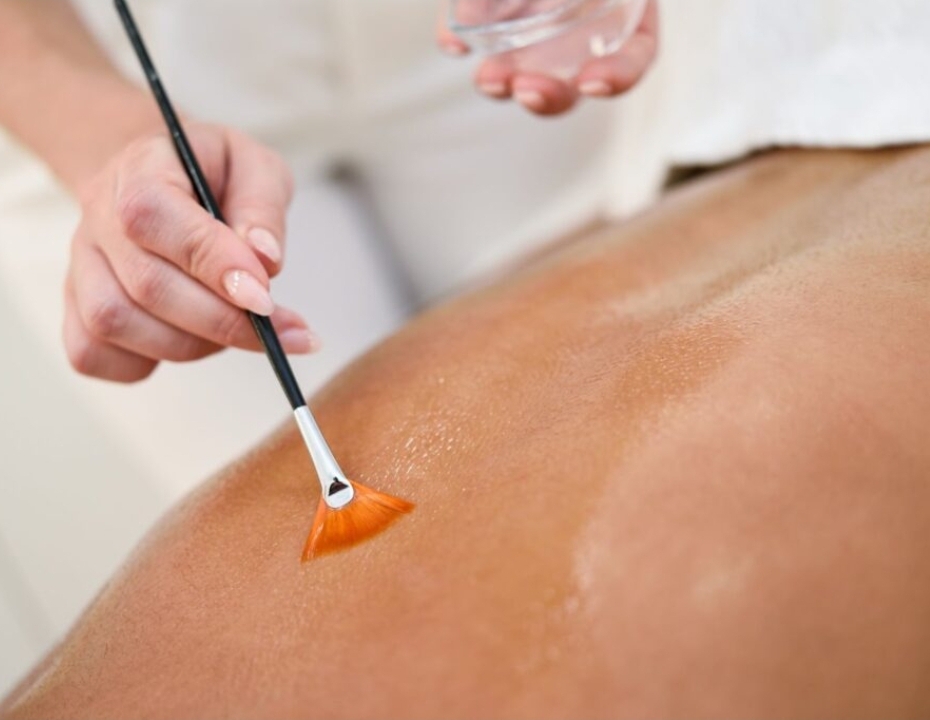 Back Treatment (Facial, Bacial) at Lux Aesthetics in Rockford, IL