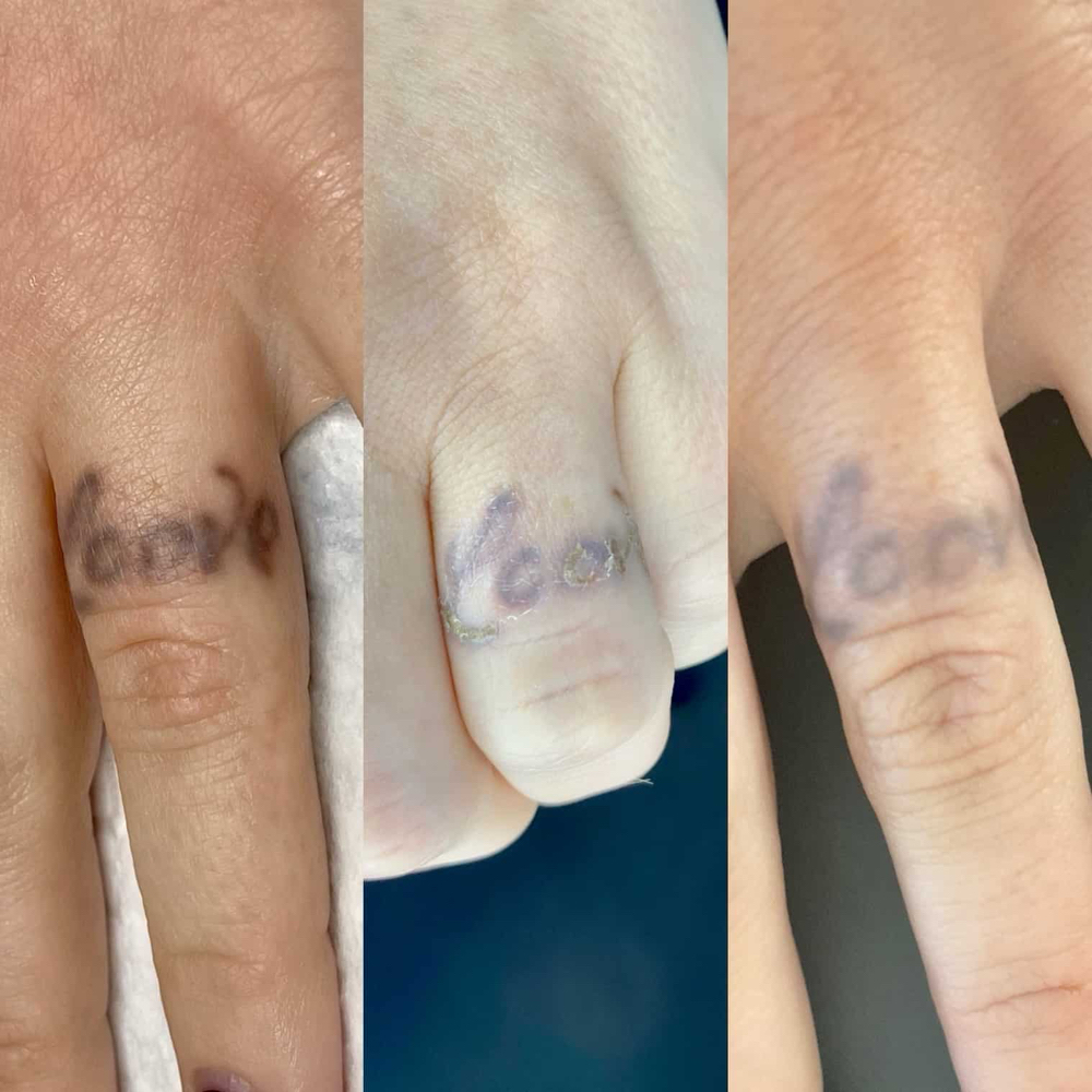 Tattoo Removal PA
