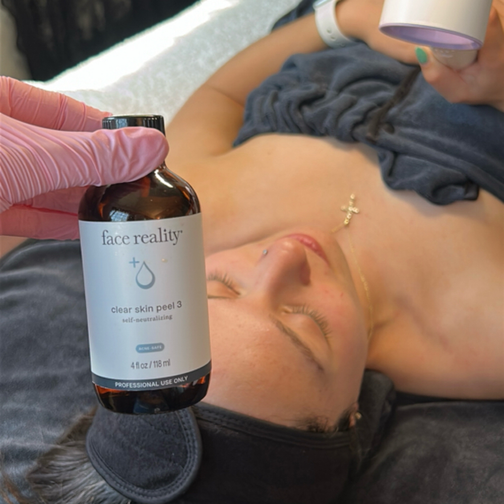 Chemical Peels at Not the Body Shop in Littleton, CO