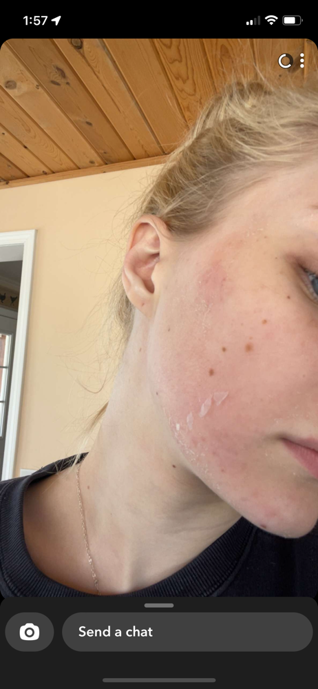 Chemical Peel