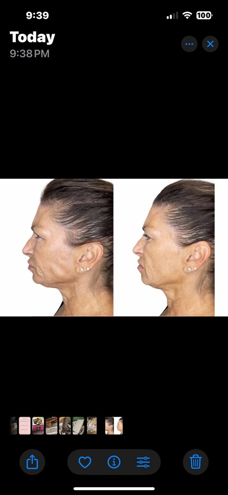 Non Surgical Face Lift