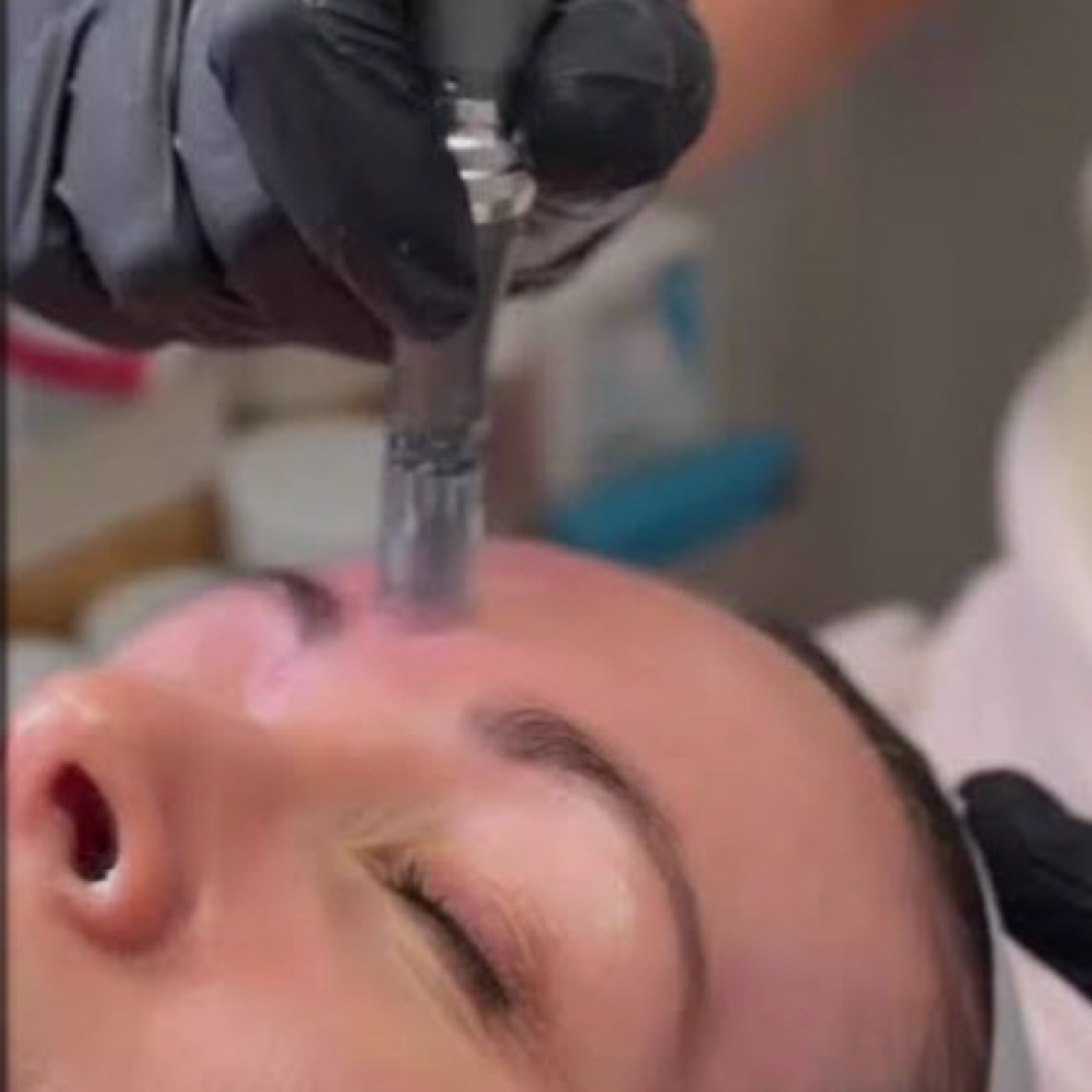 Microneedling (Collagen Induction T at Holistic Skin Center in Edgewater, FL