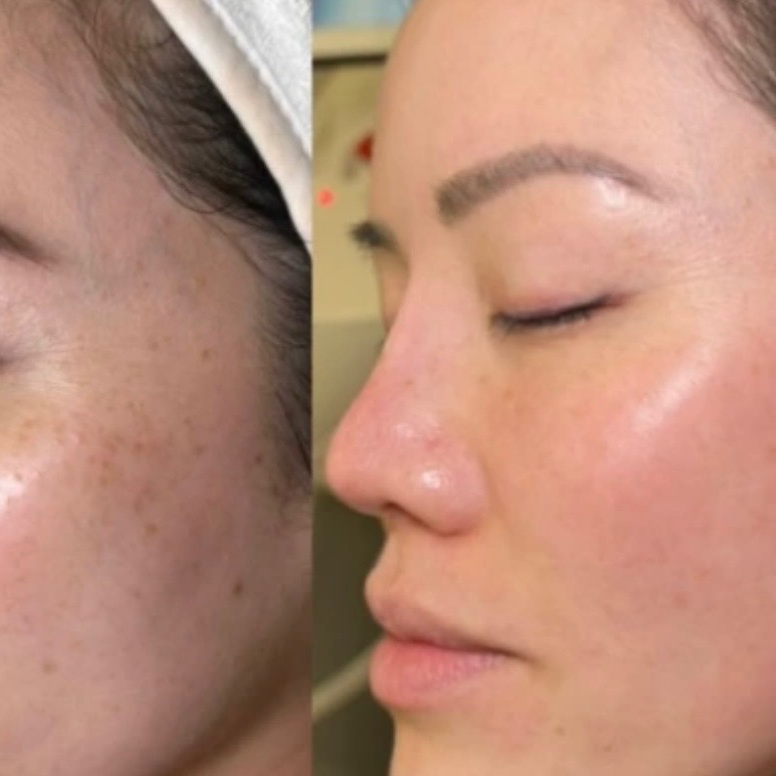 Hyperpigmentation Facial at Esthetics With Michaela in Vidalia, LA