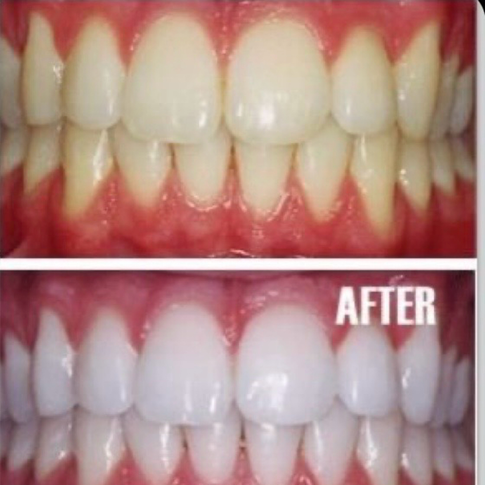 Teeth Whitening 45 Minutes at KatValentineBeauty in Columbus, OH