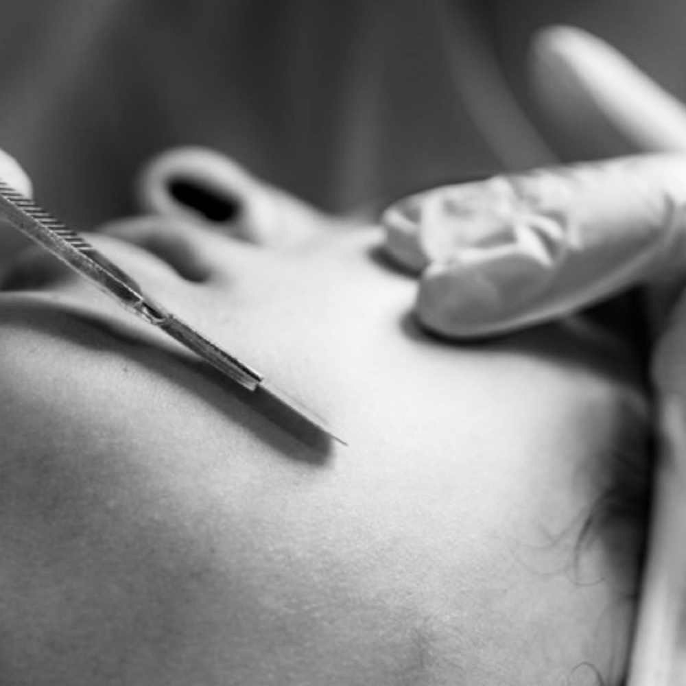 Dermaplane Only (No Facial) at Elevated Wellness NWA Skincare & Esthetics Bentonville, AR in Bentonville, AR