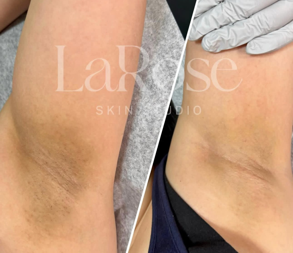 Underarm Wax + treatment