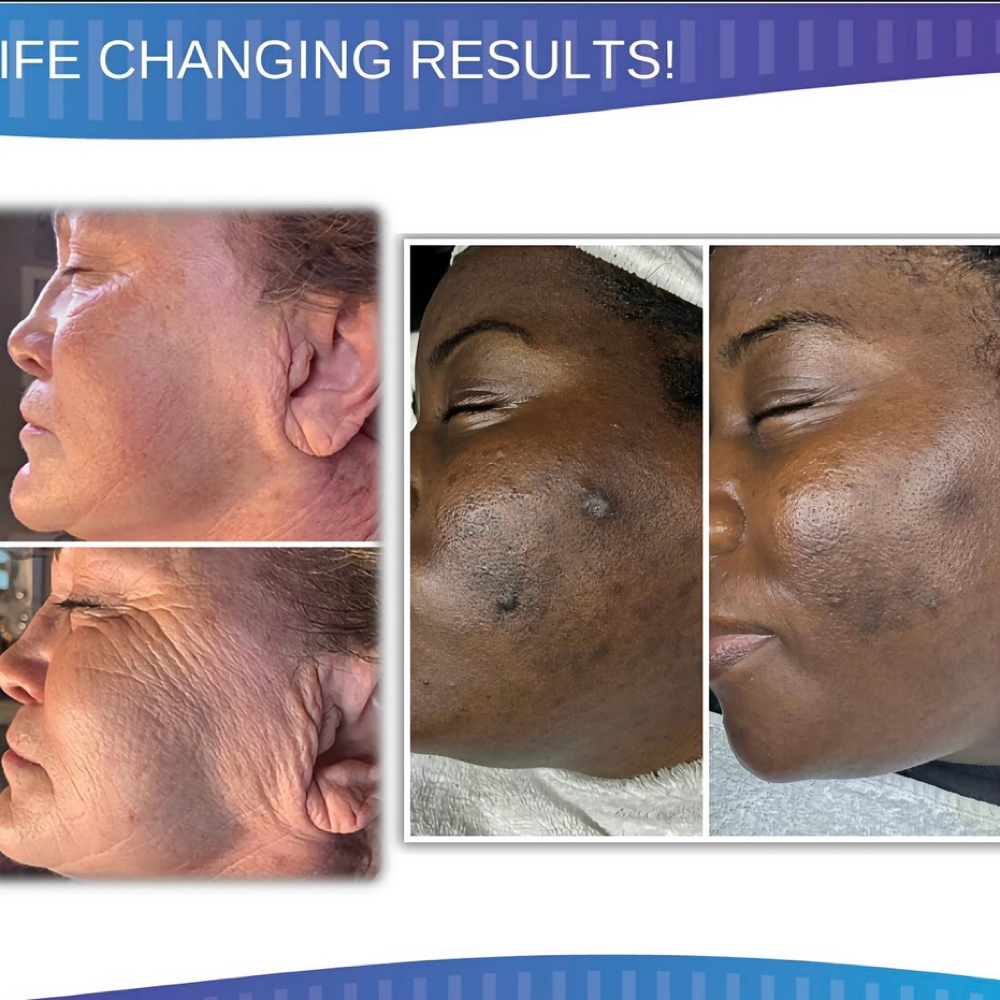 Procell Microchanneling Face at After Glow Esthetics in Galt, CA