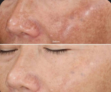 Dermaplan & PCA Sensi Chemical Peel