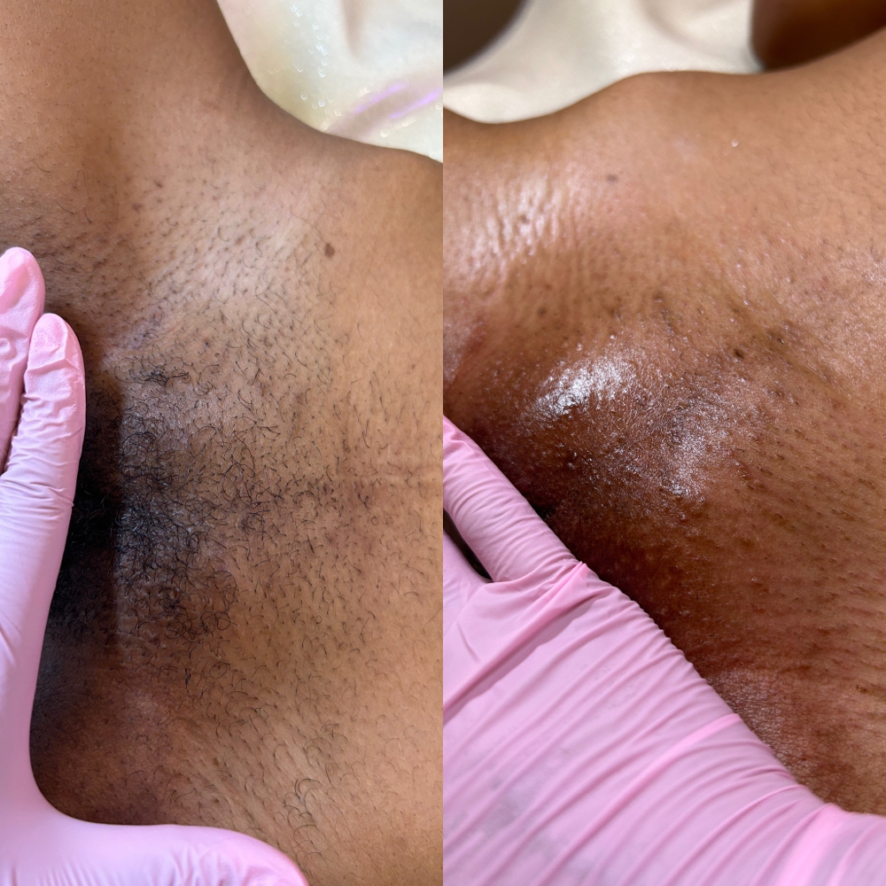 Brazilian Suagring Hair Removal