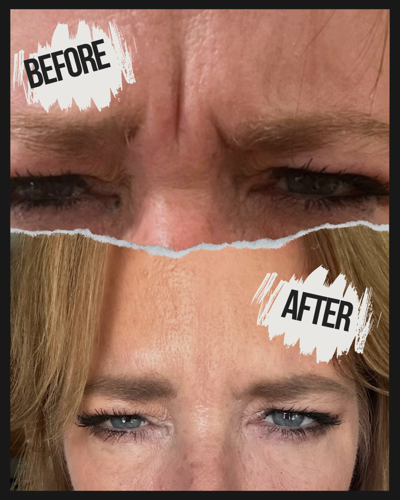 Botox Injections