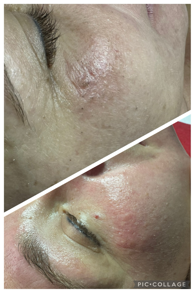 Acne treatment facial
